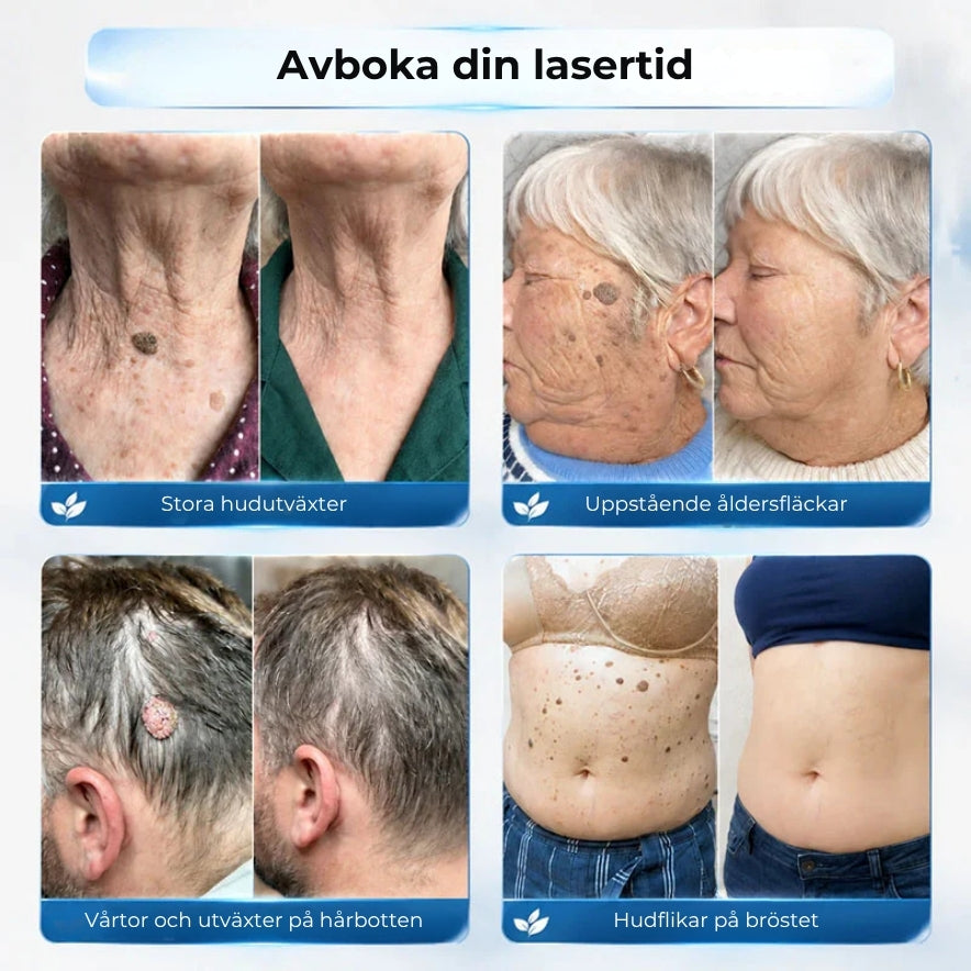 SlätHud – Smärtfri borttagning på 7 dagar